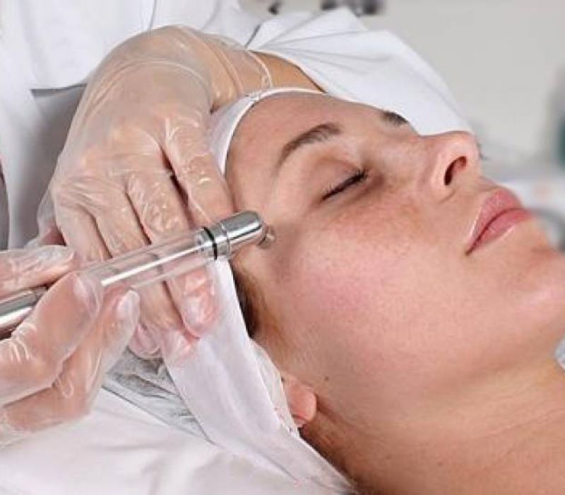 Dinarte | peeling químico